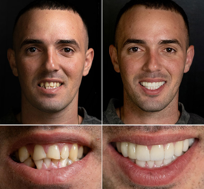 Dental Implants Before and After