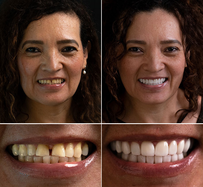 Dental Implants Before and After