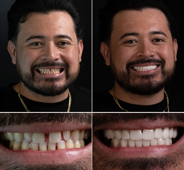 Dental Implants Before and After